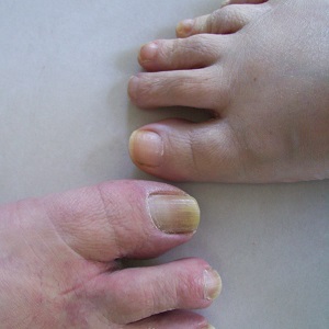 Toenails of Man and Woman 