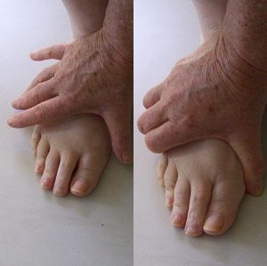 Morton's Neuroma Forefoot Squeeze test
