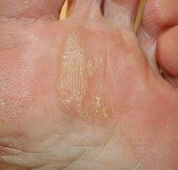 foot callus