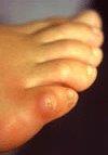 corn on toe from shoe rubbing