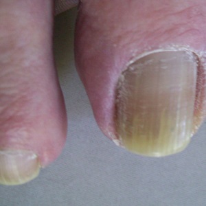 Hard to cut man's toenail