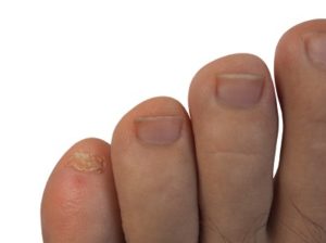 Problem pinky toenail
